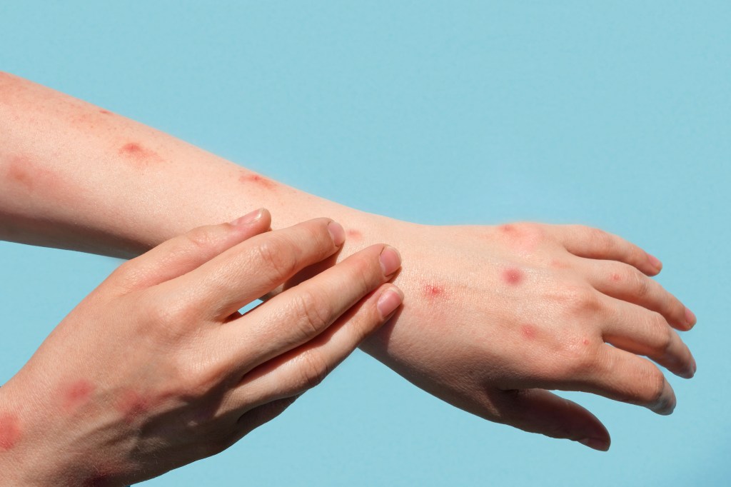 A patient displays their hands and forearms which have red spots and blisters.