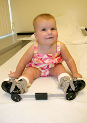 The Clubfoot Correction: How Parents Pushed For A Better Treatment