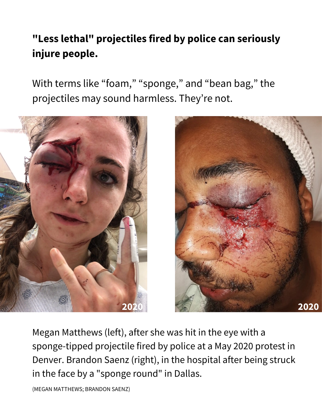 A slide that shows two images of people hurt by rubber bullets. The text reads: "Less lethal" projectiles fired by police can seriously injure people. With terms like “foam,” “sponge,” and “bean bag,” the projectiles may sound harmless. They’re not. Megan Matthews (left), after she was hit in the eye with a sponge-tipped projectile fired by police at a May 2020 protest in Denver. Brandon Saenz (right), in the hospital after being struck in the face by a "sponge round" in Dallas. (MEGAN MATTHEWS; BRANDON SAENZ)"